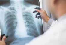 Anvisa aprova novos medicamentos para o tratamento de câncer avançado